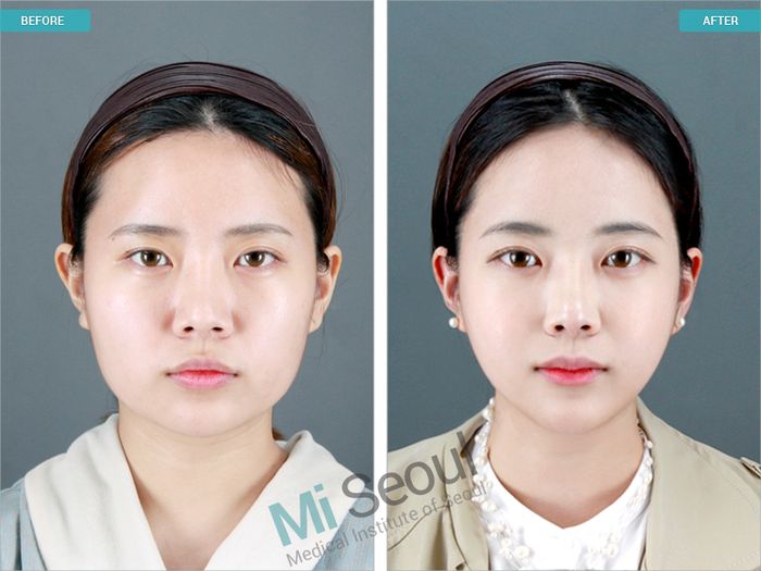 V-Line Jaw Reduction