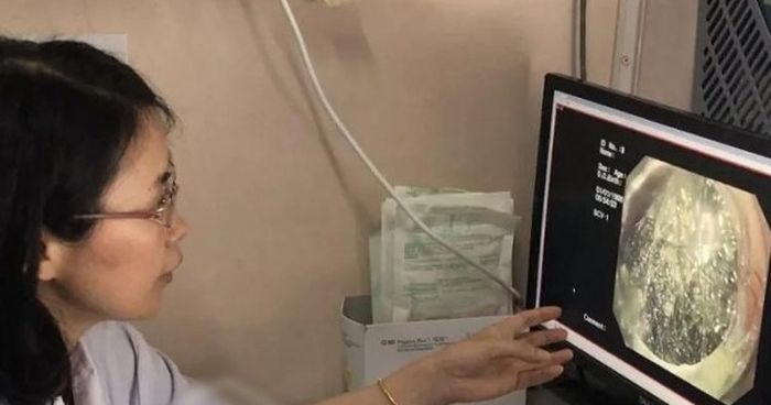 Dokter memeriksa perut gadis kecil yang berisi gumpalan rambut.