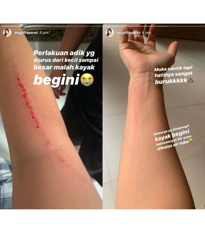 Anggita Perez menunjukkan luka diduga bekas cakaran Della Perez