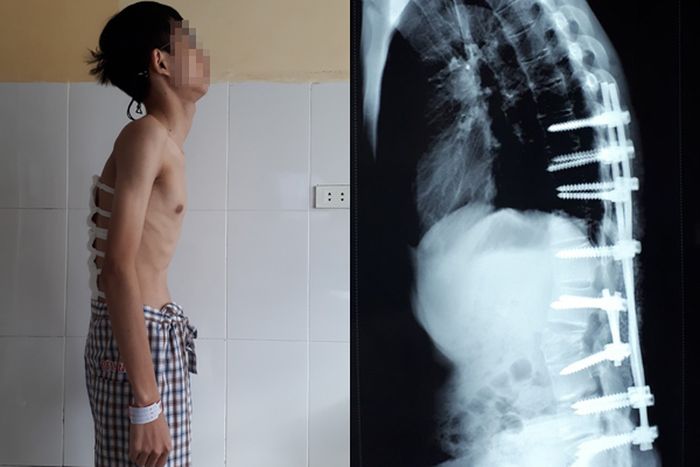 kondisi tulang belakang pasien yang mengalami kebungkukan dan telah di lakukan perbaikan