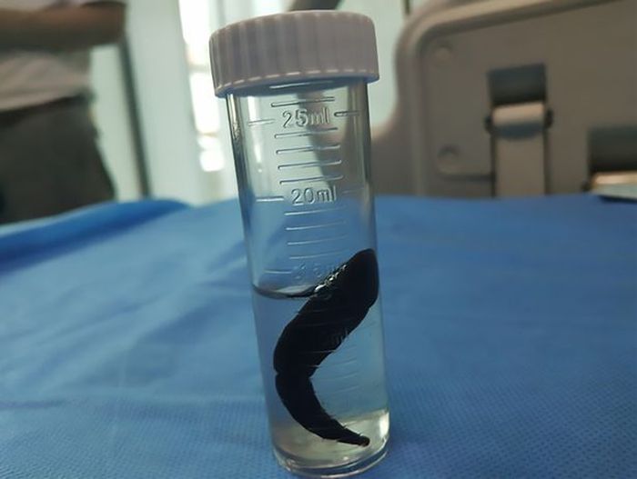 Lintah yang berhasil dikeluarkan dari trakea anak tersebut.