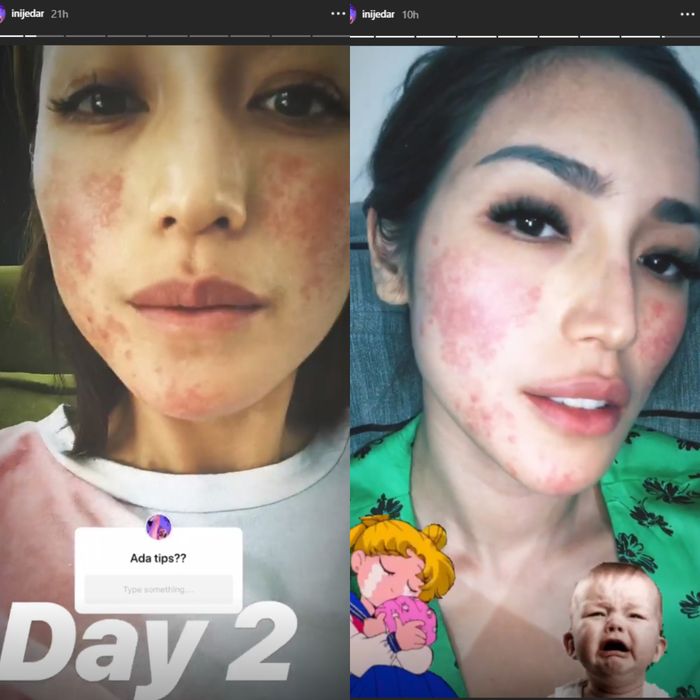 wajah Jedar memerah karena alergi