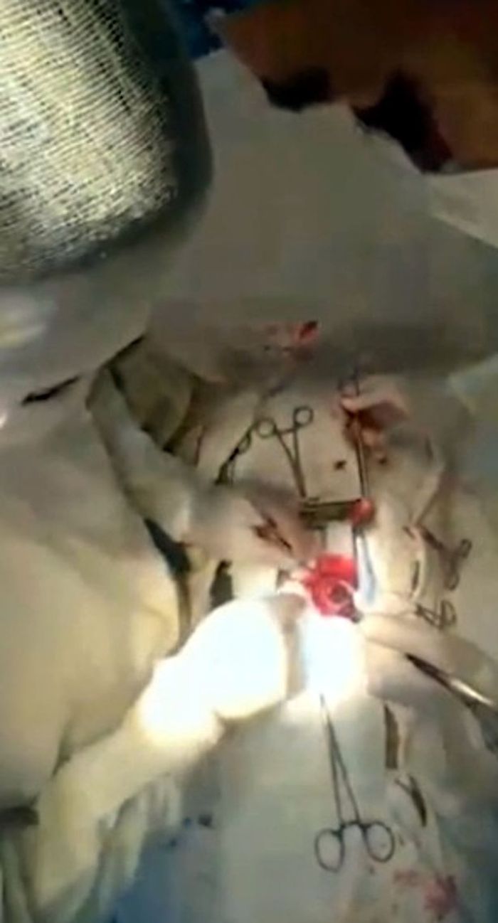 Ahli bedah mengeluarkan gumpalan rambut dari perut gadis 19 tahun