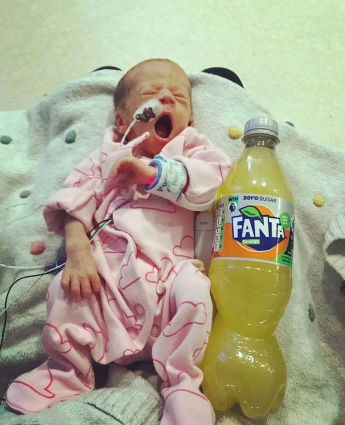 Terlahir Prematur, Bayi Kembar Ini Hanya Seukuran Botol