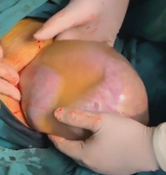 Bayi dilahirkan masih dalam kantung ketuban