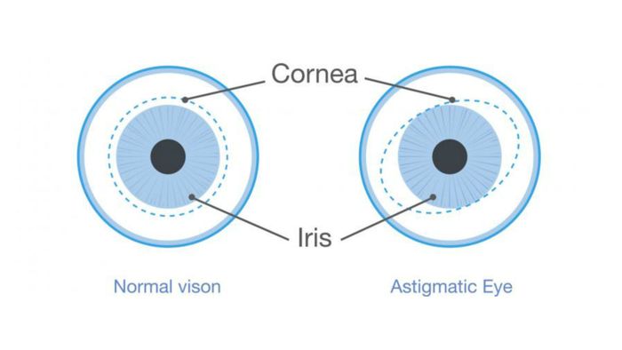 Ilustrasi Astigmatisme