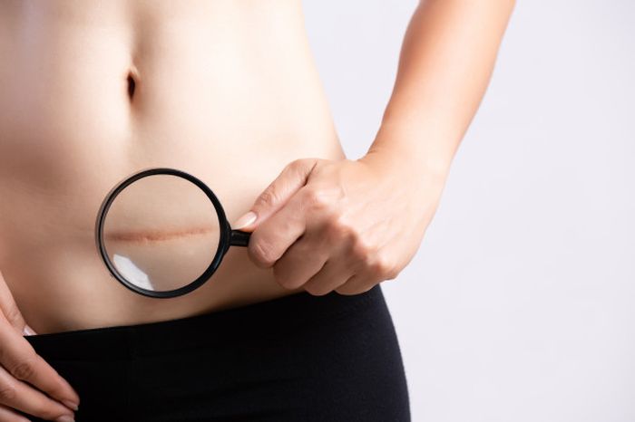 Persalinan sesar berisiko membuat anak menjadi obesitas.