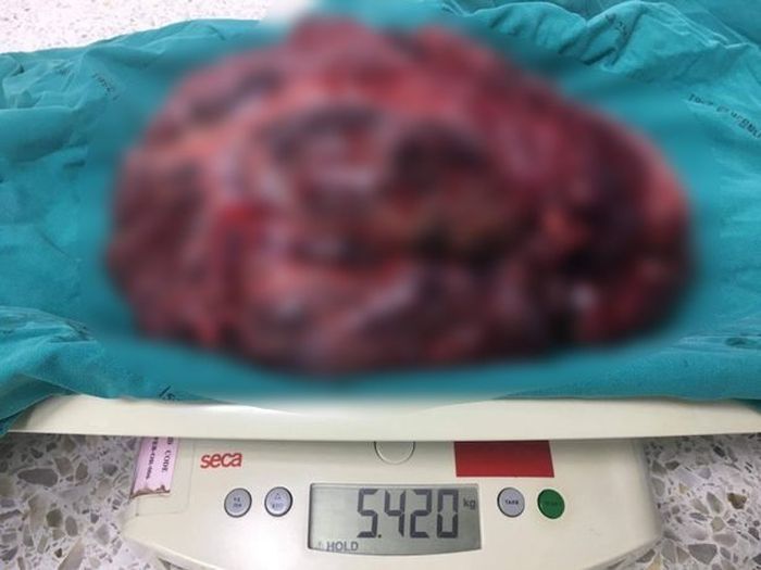 Tumor itu seberat 5,42 kg