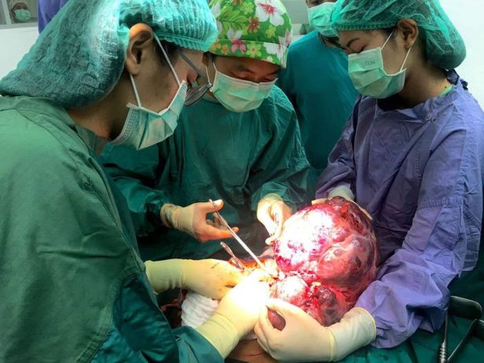 Operasi pengeluaran tumor itu memakan waktu 90 menit