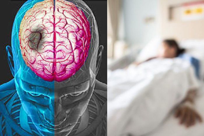 ilustrasi pasien stroke