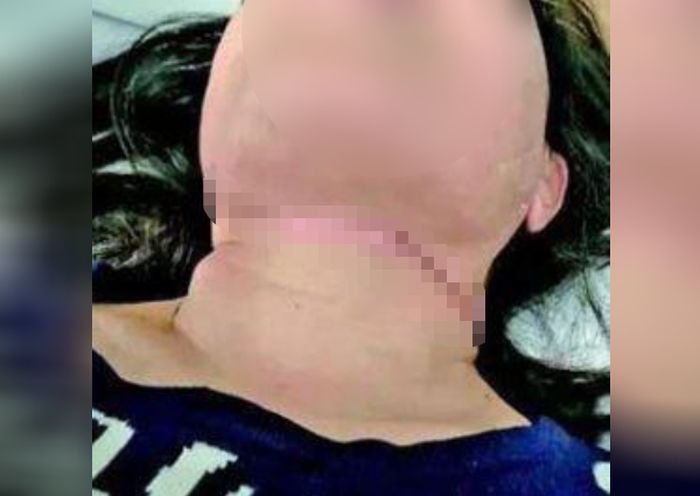 Leher Wanita Ini 'Terpotong' oleh layang-layang