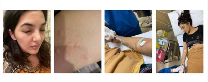 Potret kondisi Ashanty yang mengalami bentol-bentol di sekujur tubuhnya