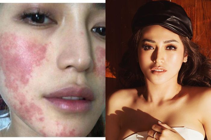 Jessica Iskandar alami iritasi usai perawatan wajah