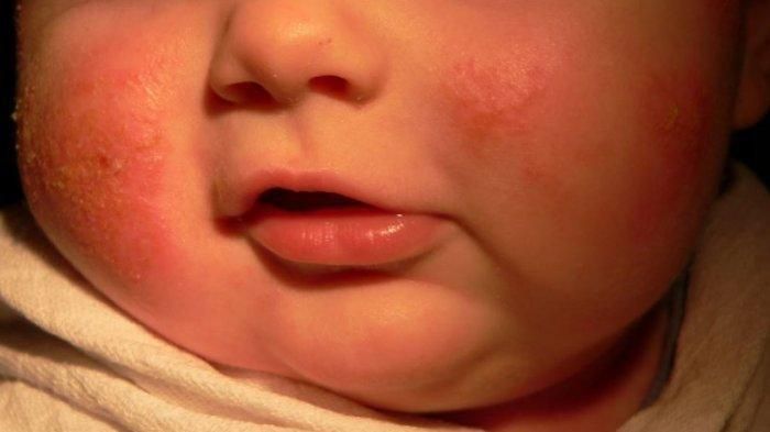 Kenali Dermatitis Atopik pada Bayi dan Anak Serta Cara Penagobatan yang Mudah