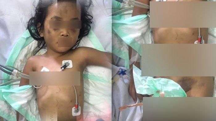 Bocah 4 tahun di Surabaya mengalami lebam di sekujur tubuh dan mengigau minta ampun