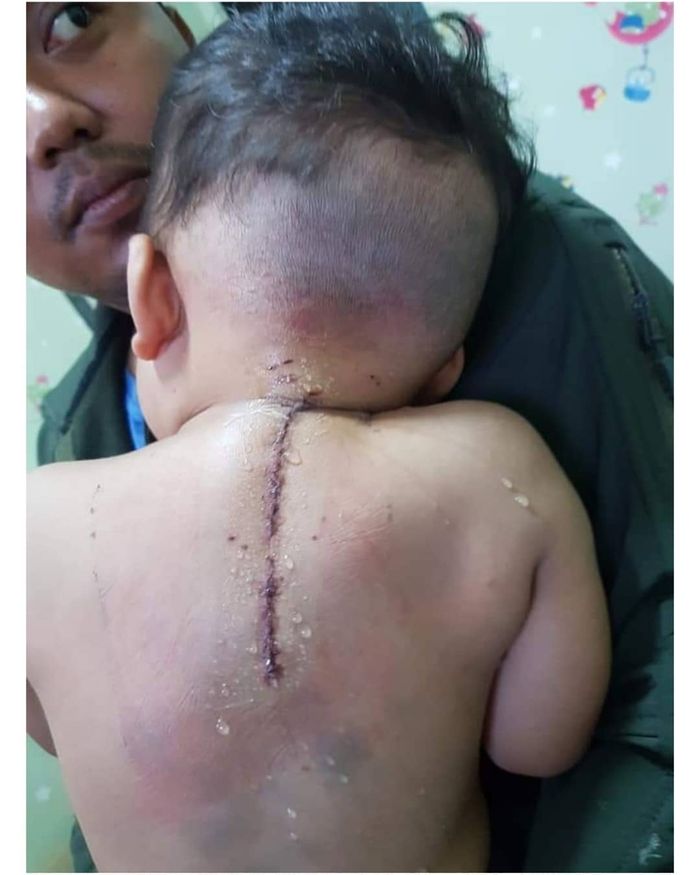 Si anak setelah berhasil dioperasi.