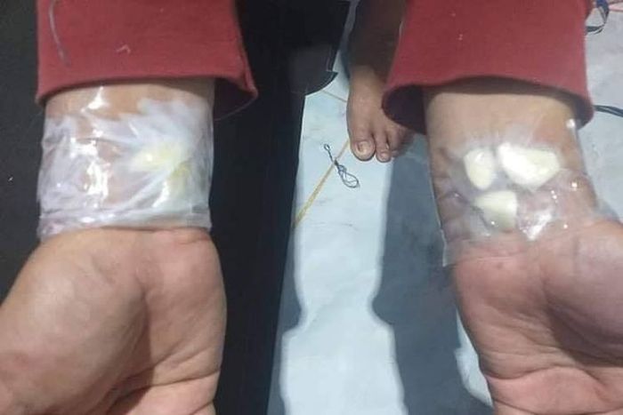 Viral tempel bawang putih di tangan bisa atasi sakit gigi.