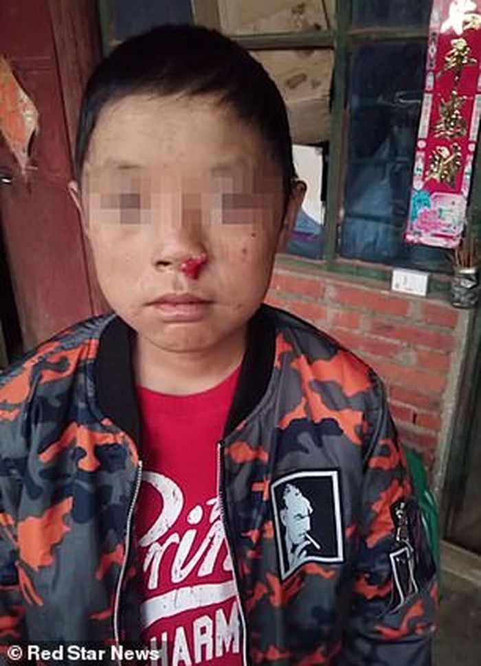 Seorang bocah mendadak menjadi drakula.