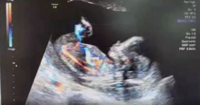 Dokter gagal menemukan janin wanita tersebut.
