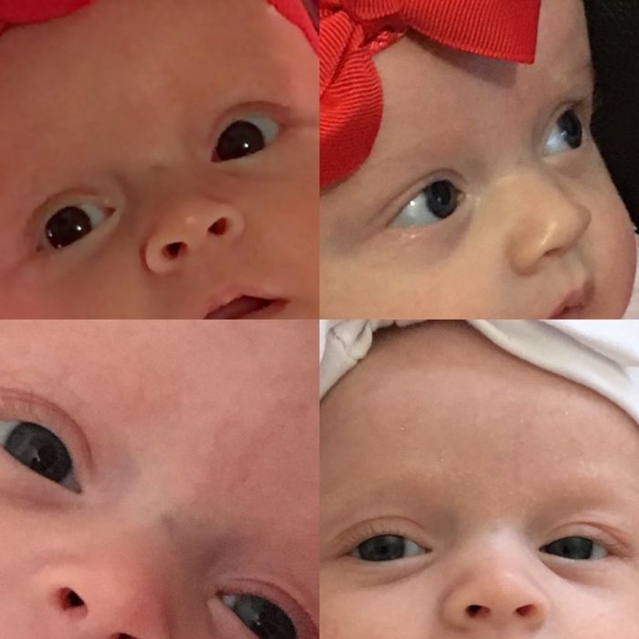 Sugar bug pada bayi akan hilang dengan sendirinya.