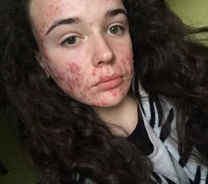 Jerawatnya tumbuh di pelipis, pipi, dagu, dan dahi, sementara para dokter tidak tahu mengapa. Sakit sakitnya bahkan Mariah kesulitan untuk tidur sehingga harus menelan kombinasi pil tidur dan Ibuprofen.