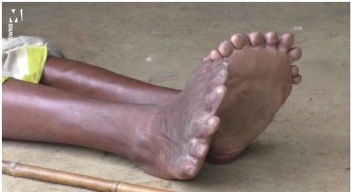 Penampakan jari kaki Kumari Nayak.