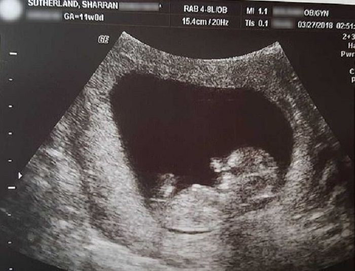 
Scan janin Sharran dalam kandungan