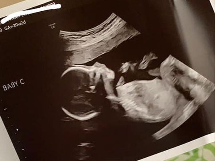 Hasil USG bayi Hannah dalam keadaan stabil