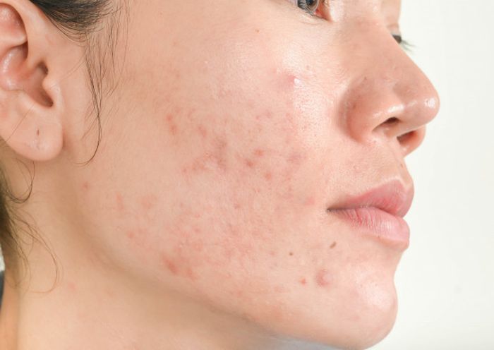 Ilustrasi muncul jerawat karena kuas makeup