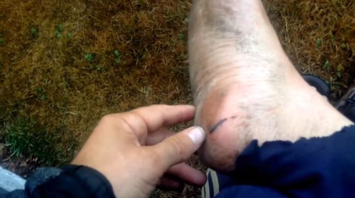 Luka yang ditutupi sarang laba-laba