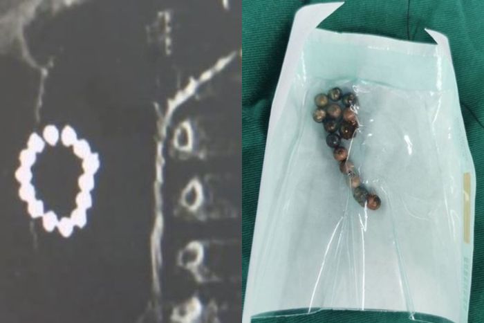 Kolase foto hasil pemeriksaan dan logam yang telah dikeluarkan dari perut putra Dai.