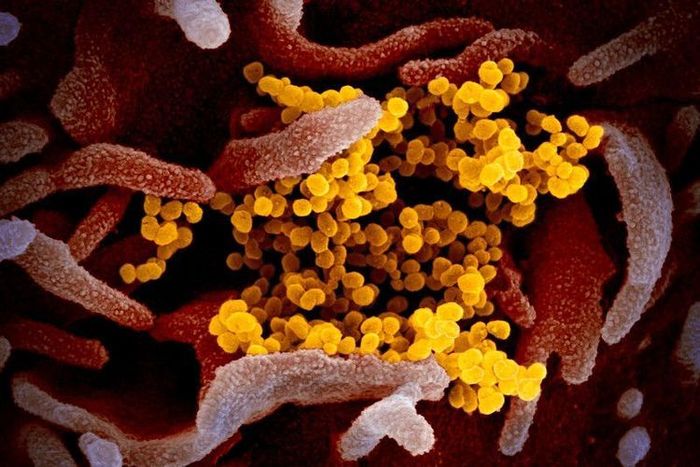 kompas.com__ Gambar mikroskop elektron pemindai ini menunjukkan virus corona Wuhan atau Covid-19 (kuning) di antara sel manusia (merah). Sampel virus diambil dari seorang pasien AS yang terinfeksi. Para ahli menambahkan gambar agar lebih tampak.