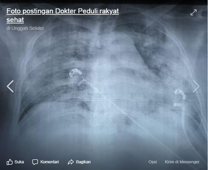 Foto-2 hasil rontgen nakes yang meninggal karena Covid-19