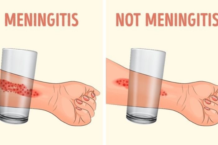 Cara memeriksa meningitis menggunakan gelas kaca