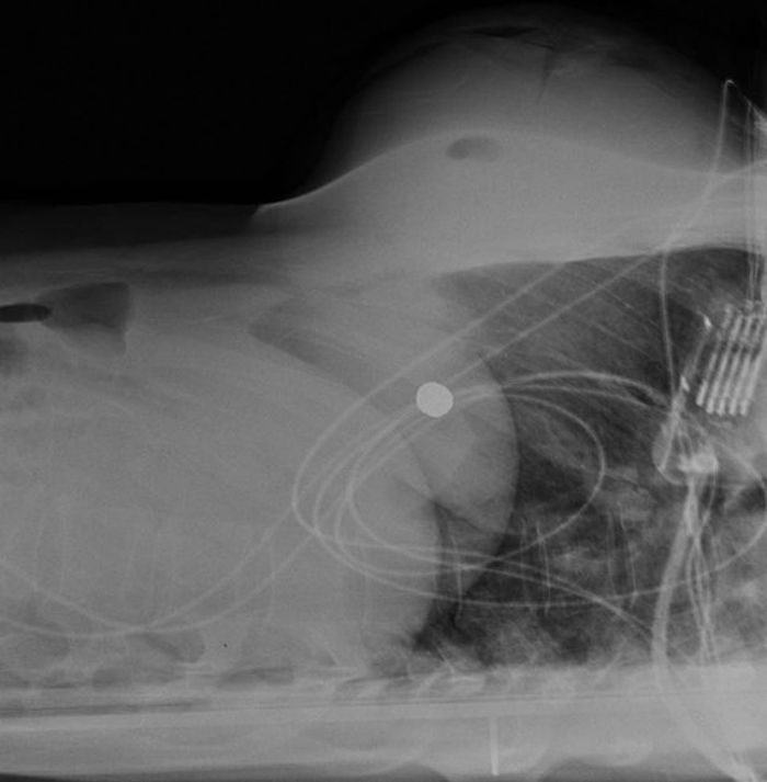 X-ray menunjukkan peluru bersarang di tulang rusuk korban