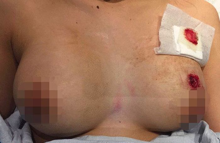 Luka di dada korban, yang mungkin akan jauh lebih buruk jika tidak ada implan di payudaranya