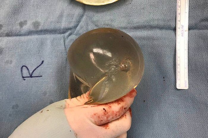 Implan silikon, dikeluarkan dari wanita, menunjukkan kerusakan peluru