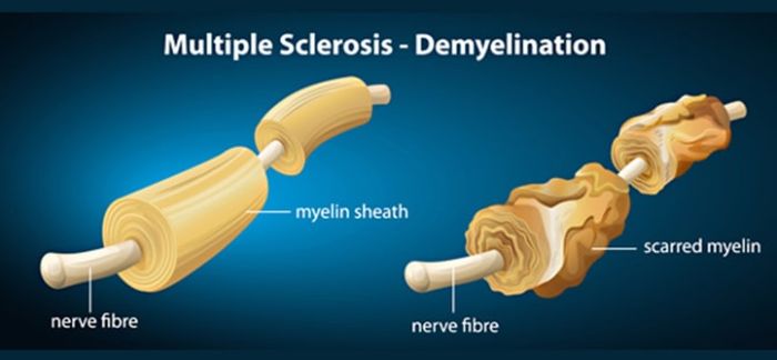 Tanda penyakit multiple sclerosis mulai menyerang saraf.