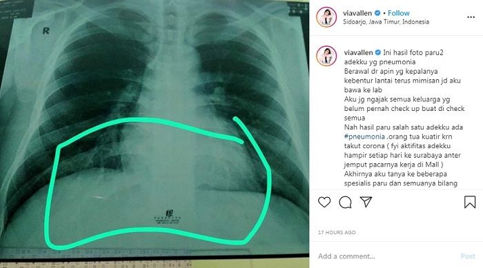 Unggahan Via Vallen yang mengabarkan adiknya positif virus corona.