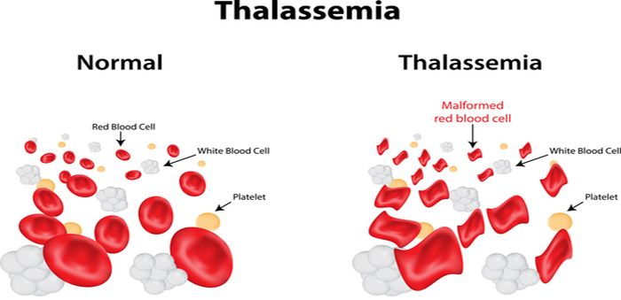 Adalah thalassemia Penyebab Thalasemia