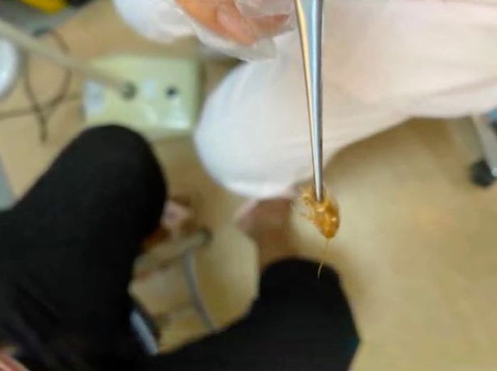 Dokter mengangkat kecoak dari dalam telinga pasien.