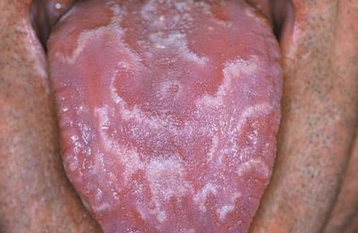 Inilah yang dinamakan Geographic tongue
