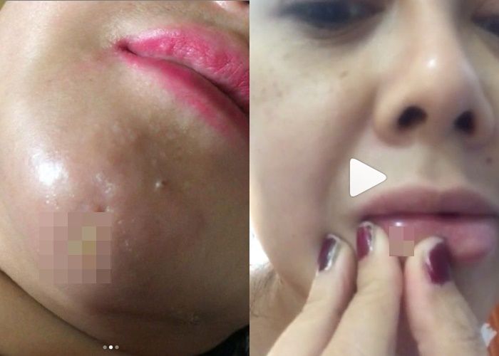 Dagu dan bibir Rency Milano mengeluarkan nanah