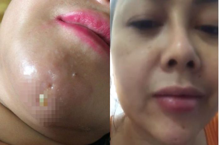 Potret <a href='https://manado.tribunnews.com/tag/wajah' title='wajah'>wajah</a> <a href='https://manado.tribunnews.com/tag/rency-milano' title='Rency Milano'>Rency Milano</a> usai menjadi korban malpraktek <a href='https://manado.tribunnews.com/tag/klinik-kecantikan' title='klinik kecantikan'>klinik kecantikan</a>.