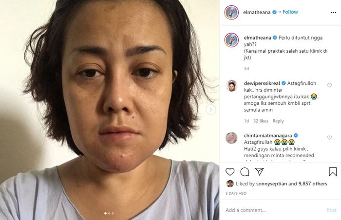 Unggahan Elma Theana tentang Rency Milano yang diduga menjadi korban malapraktik klinik kecantikan.
