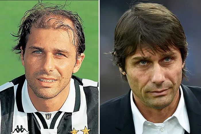 Pelatih Inter Milan, Antonio Conte, sebelum dan sesudah melakukan transplantasi rambut.
