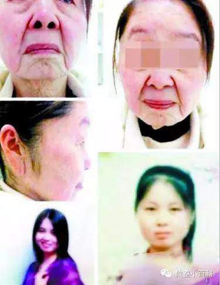 Penampakan wajah Ho Quyen sebelum dan sesudah.