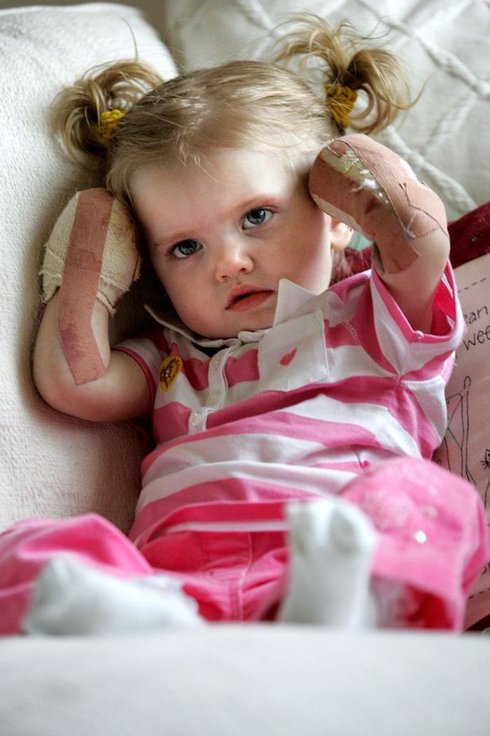 Tilly Lockey saat usia-nya 15 bulan