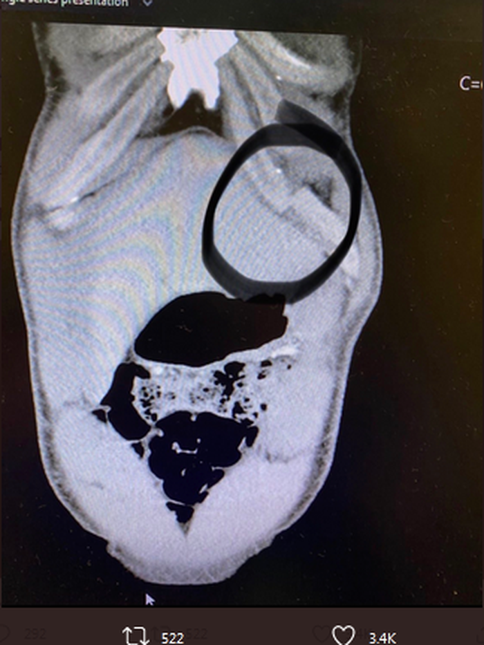 X-Ray kondisi tulang petarung, Tyron Woodley pasca bentrok dengan Colby Covington ada UFC Fight NIght 178 Minggu (20/9/2020).