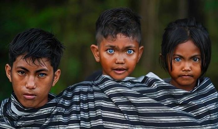 Mereka pengidap Waardenburg Syndrome.